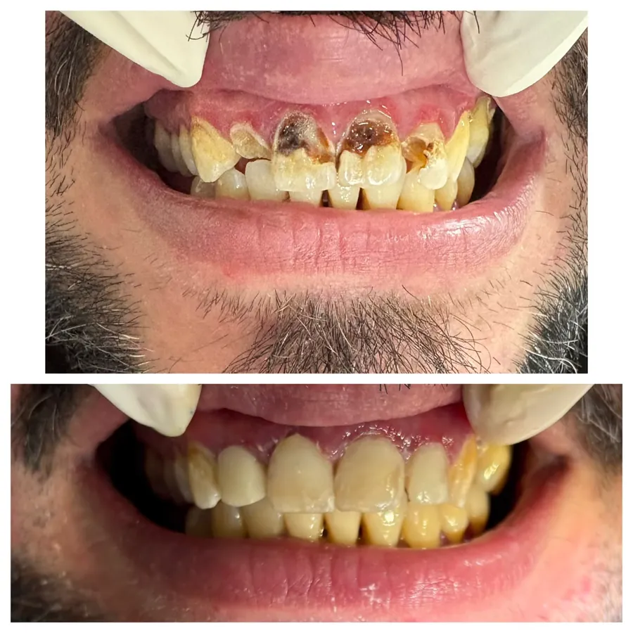 Caso real: sonrisa antes y después del tratamiento