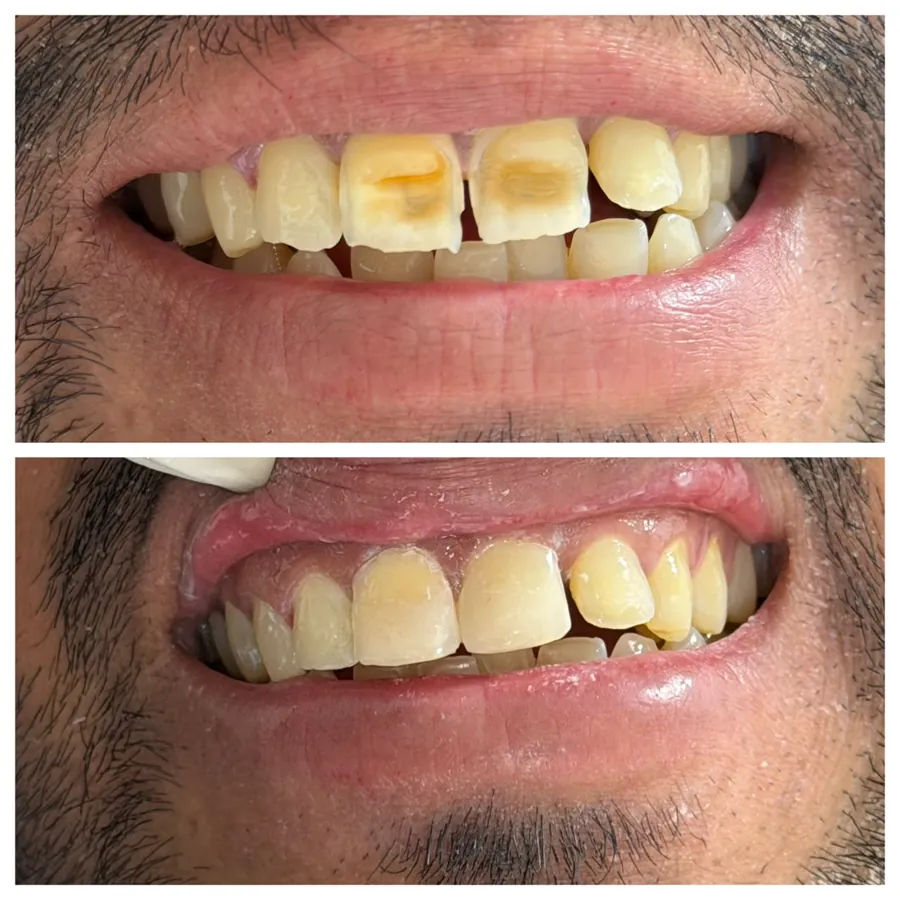 Caso real: sonrisa antes y después del tratamiento