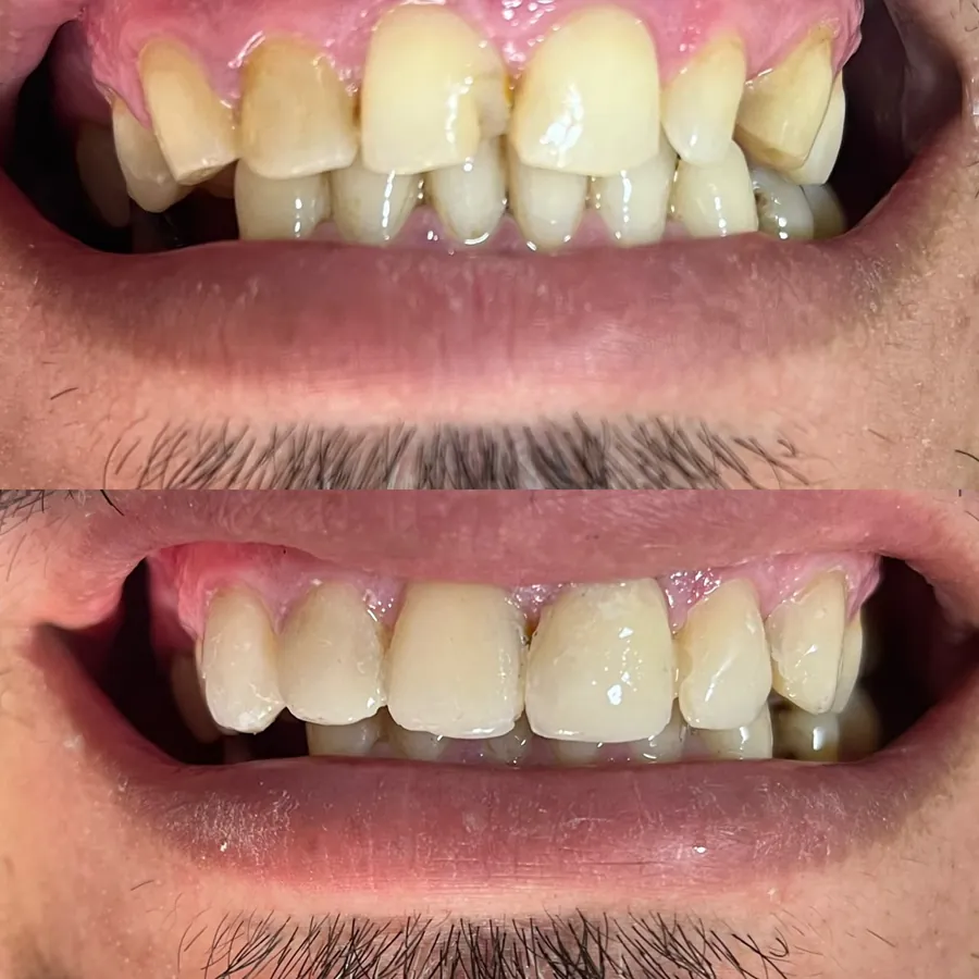 Caso real: sonrisa antes y después del tratamiento