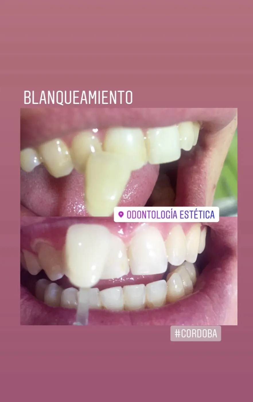 Caso real de blanqueamiento, antes y después