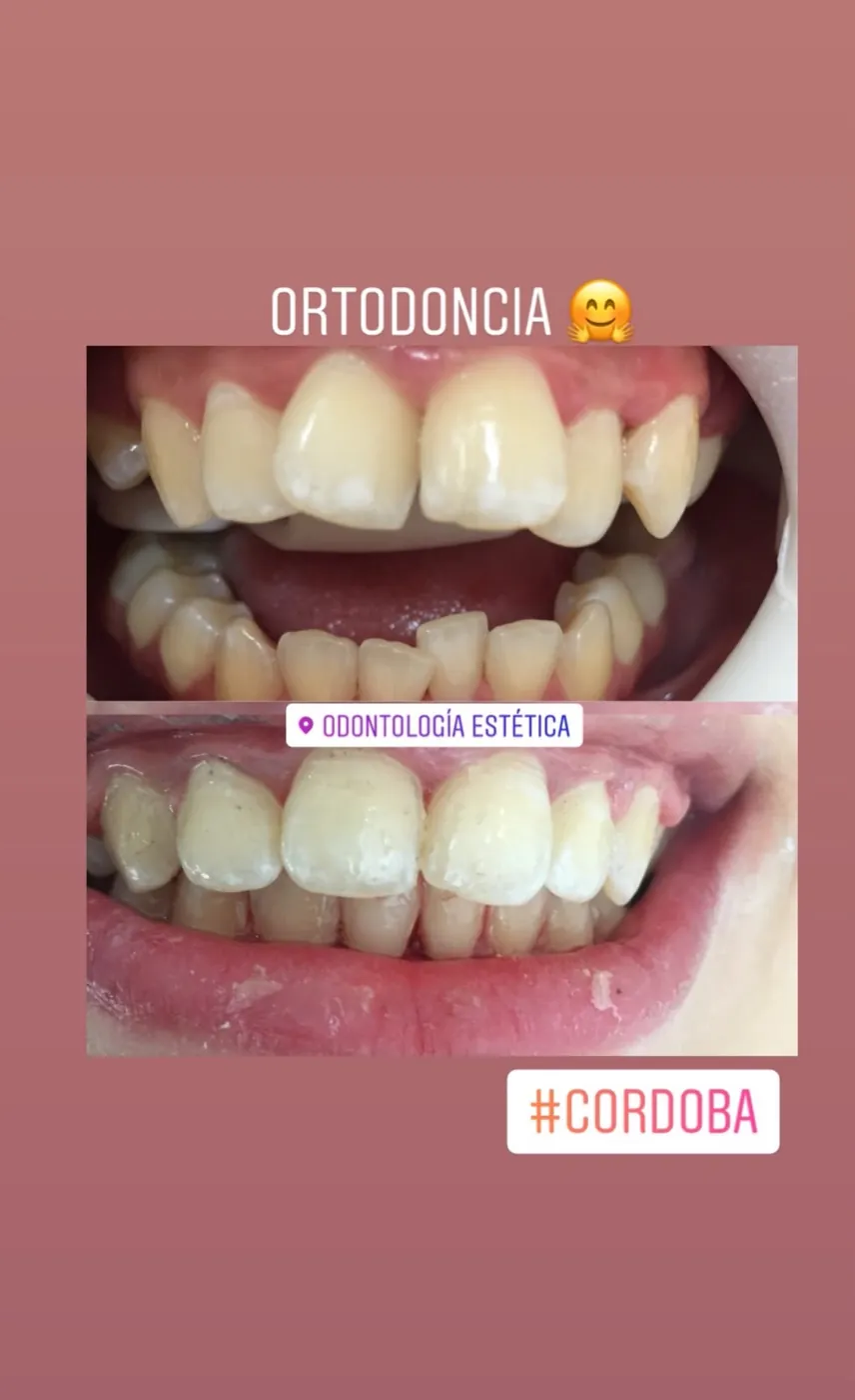 Caso real de ortodoncia, antes y después